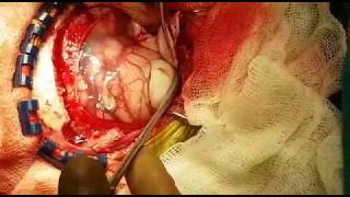 Intracranial Hydatid cyst: Removal by Hydrodissection Video 1