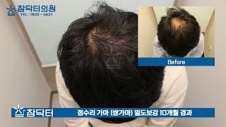 누구나 하고 싶어도 아무나 하지 못하는 정수리탈모 모발이식, 암흑기 염려없는 밀도보강 입니다! [참닥터의원]