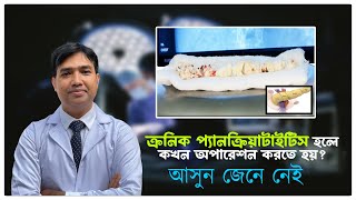 ক্রনিক প্যানক্রিয়াটাইটিস হলে কখন অপারেশন করতে হয়? আসুন জেনে নেই | chronic pancreatitis