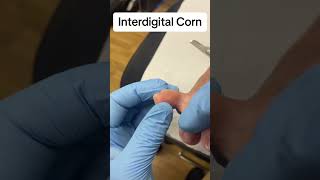 Painful corn between the toes (interdigital) removed from foot by podiatrist