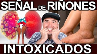 ALERTA! TUS RIÑONES ESTAN INTOXICADOS - 5 Sintomas Y Soluciones Para Regenerarlos