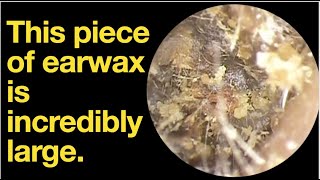 This piece of earwax is incredibly large.|ear wax removal | ear cleaning | ASMR | relaxation | relax