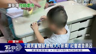 2歲男童雙腳.臉頰大片瘀青! 社會處查原因