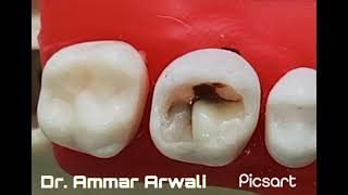 Composite Carving Cusp by Cusp Part I Upper Molar..Dr Ammar Arwali