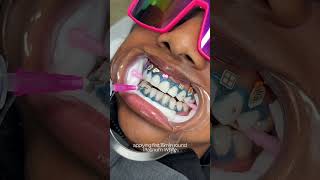 teeth whitening transformation 🦷 #teethwhitening #torontoteethwhitening