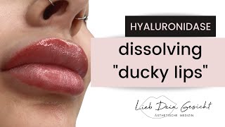 Dissolving Lip Filler