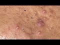 Nasa SPA #001 - Satisfying Blackhead, acne relaxing 2021.