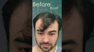 Hair Transplant Results Frontal + Crown #shorts