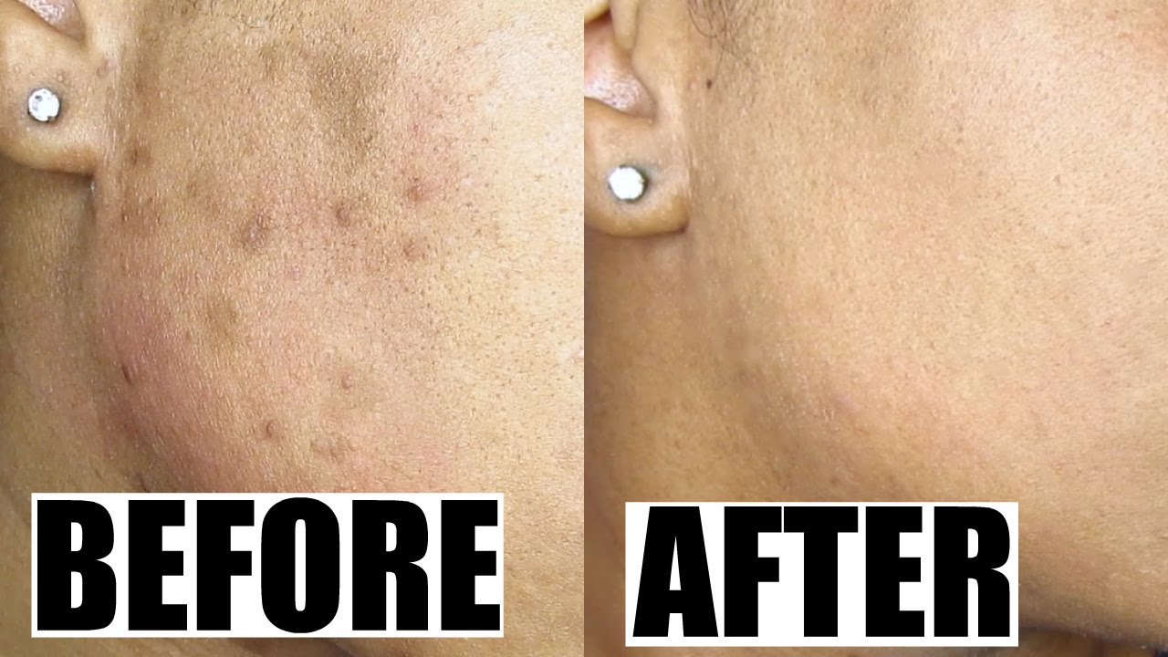 How To Get Rid Of Acne Scars Permanently | Banish Acne Scars Demo ...