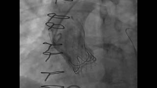 Valve-In-Valve Procedure Under Fluoroscopy