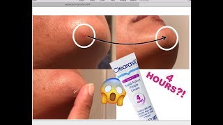 TESTING CLEARASIL 4HOUR PIMPLE TREATMENT - DOES IT WORK?