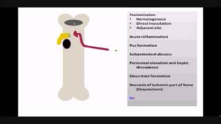 Pathogenesis of Acute Osteomyelitis