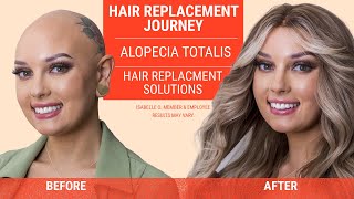 Alopecia Totalis and my Hair Replacement Journey