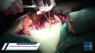 Serdar Nasır MD. / Plastic Surgery - Female to Male Transgender Surgery