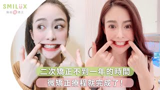 【SMILUX樂齒微矯正】小青 - 二次矯正不到一年的時間，微矯正療程就完成了！｜隱形微矯正｜隱形牙套｜SOV舒服美​​