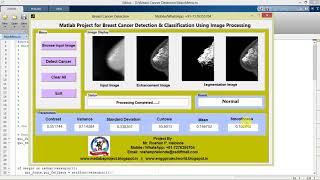 Matlab Code for Breast Cancer Detection Using Image Processing