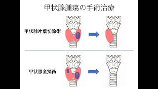 【頭頸部外科月間②】甲状腺腫瘍について