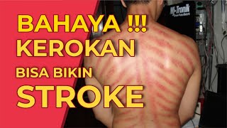 Kerokan Bikin Stroke! Benarkah?- Mitos vs Fakta