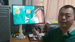 拇外翻矫正，双足拇外翻手术是不是可以一起做呢？hallux valgus