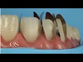 Direct veneering using composite resin with new unica proximal matrix- the simplified approach