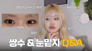 28살 첫쌍수 \u0026 눈밑지 한달차 솔직 Q\u0026A ✨ | 병원, 만족도, 계기, 붓기