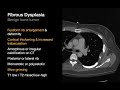 chest wall u0026 diaphragm disorders chest radiology essentials