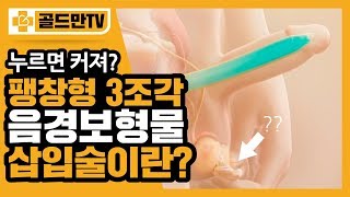 팽창형 3조각 음경보형물 삽입술이란?- [골드만비뇨기과]