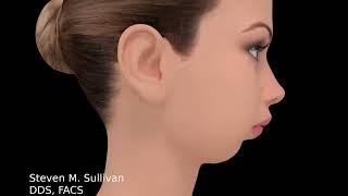 TMJ Total Joint Replacement animation | Dr. Steven Sullivan