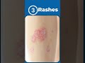 5 Signs of Autoimmune Disease #rheumatoidarthritis #lupus #psoriaticarthritis #autoimmunedisease