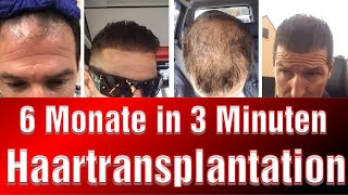 Haartransplantation 6 Monate Zeitraffer Haartransplantation Bilder Vorher Nachher