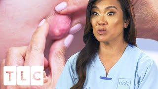 "It's Like A Rock”: Dr Lee Removes A Rare Hard Cyst | Dr. Pimple Popper