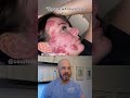 Dermatologist reacts to SEVERE acne! #dermreacts #doctorreacts #severeacne