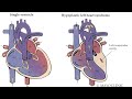 Mayo Clinic-Hypoplastic Left Heart Syndrome