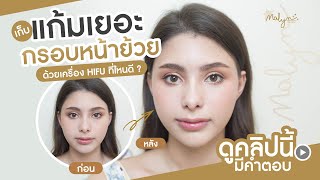 เก็บแก้มเยอะ กรอบหน้าย้วย ด้วยเครื่อง Hifu ที่ไหนดี? ดูคลิปนี้มีคำตอบ