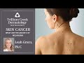 Skin Cancer Screenings – What are the ABCDE's of Melanoma?