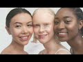 albinism beauty beyond color