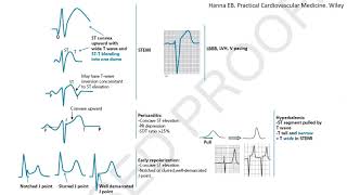 ST elevation on ECG, part 1: Differential diagnosis and case studies- STEMI mimickers, subtle STEMI