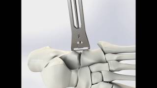 Comprehensive Nitinol System - HiMax® Surgical Technique Animation