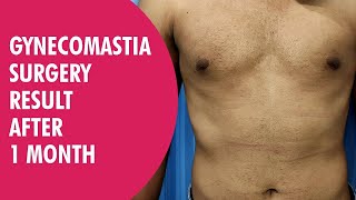 Result of Gyno Surgery After 1 Month