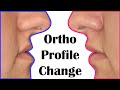 Skeletal open bite treatment and orthodontics braces - treatment lecture