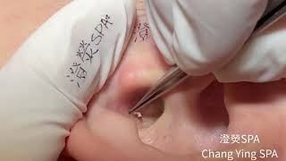 耳朵黑頭又來了！ Blackheads on ear Removal!!