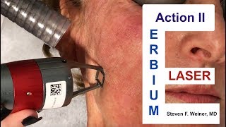 Action II Erbium Laser