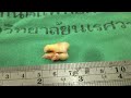 ผ่าฟันคุดกรามล่างขวา surgical removal of impacted tooth