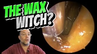 THE WAX WITCH? 285 #ear #earwax #earwaxremoval #earcleaning #fyp #asmr #foryou #