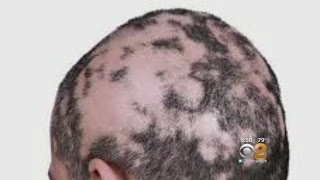 Dr. Max Gomez: Alopecia Treatment