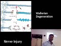 Wallerian Degeneration - Nerve Injury