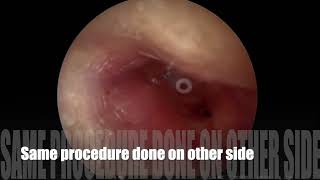 Endoscopic myringotomy with grommet insertion