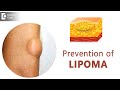 Prevent Lipomas From Occurring | Fatty Lump | Fatty Tumor - Dr. Sahebgowda Shetty | Doctors' Circle