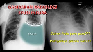 GAMBARAN RADIOLOGI EFUSI PLEURA...Rontgen cairan pada paru paru??