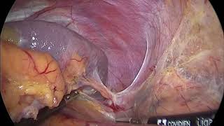 Lap Radical Nephrectomy left